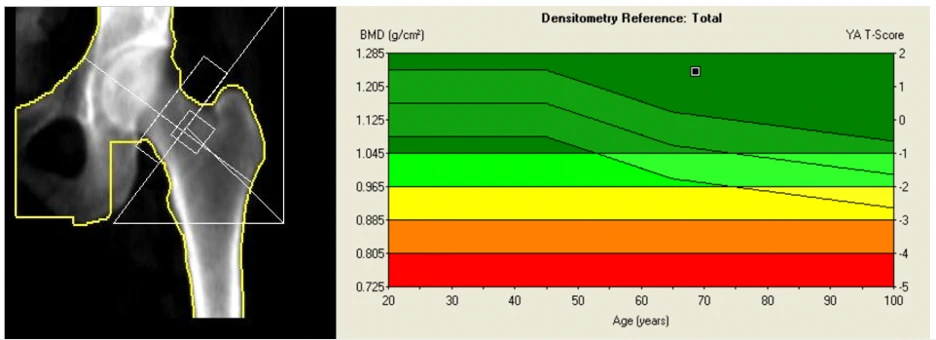 Marie's hip DEXA scan after: T-score +1.6, healthy bone range